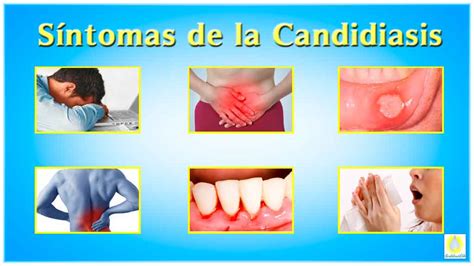 Candidiasis mamaria (hongos en el pecho): qué es, síntomas y ...